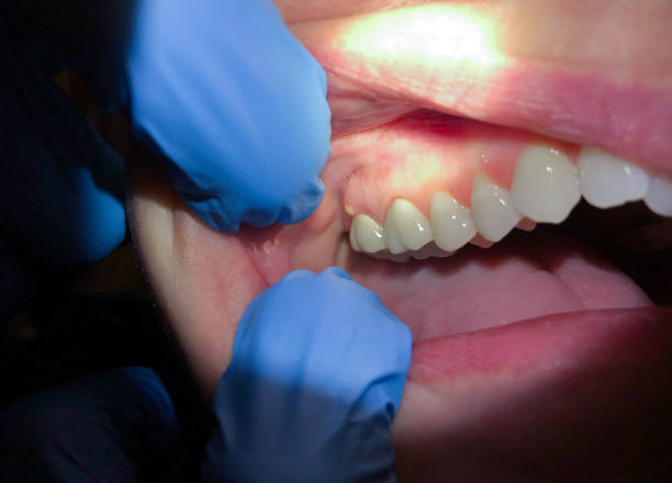 Best Knocked-Out Tooth (Avulsed Tooth) Treatment in Grand Haven, MI